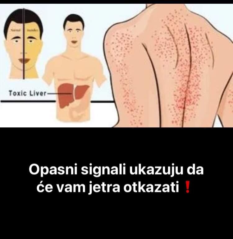 Pogledajte kako prepoznati da ce vam jetra uskoro otkazati