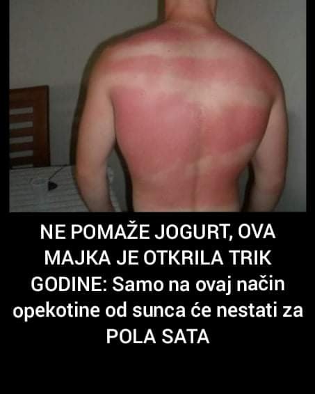 Evo kako ukloniti opekotine od sunca