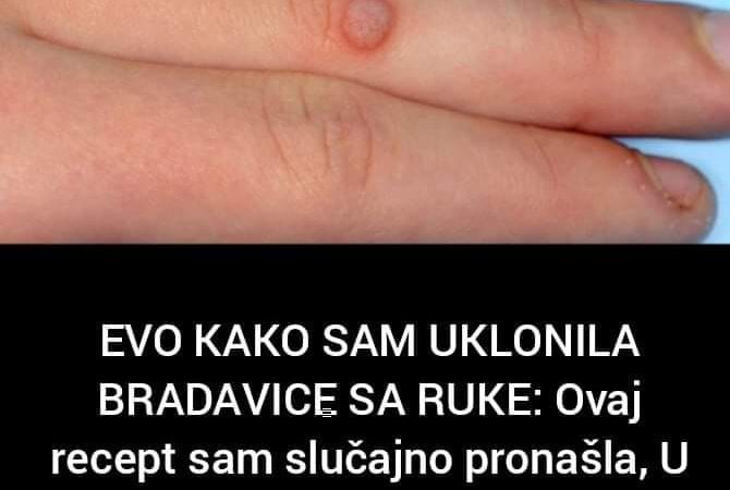 Pogledajte prirodni recept za uklanjanje bradavica na rukama