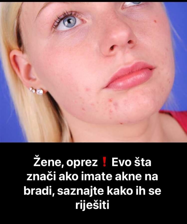 Pogledajte na koje vas probleme mogu upozoravati akne