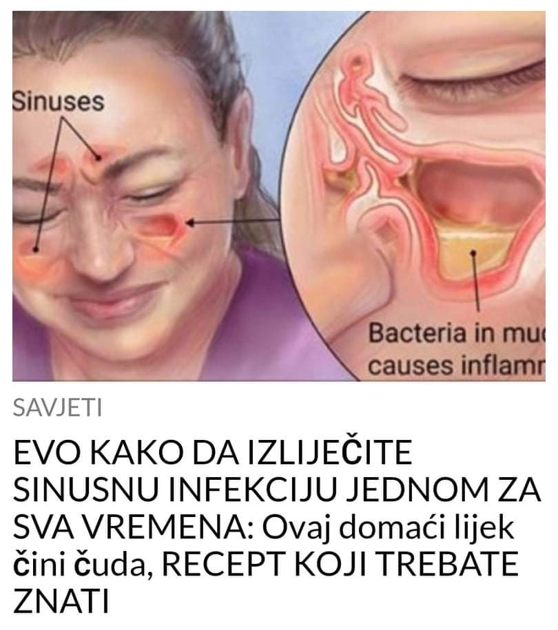 Pogledajte kako da izliječite sinusnu infekciju