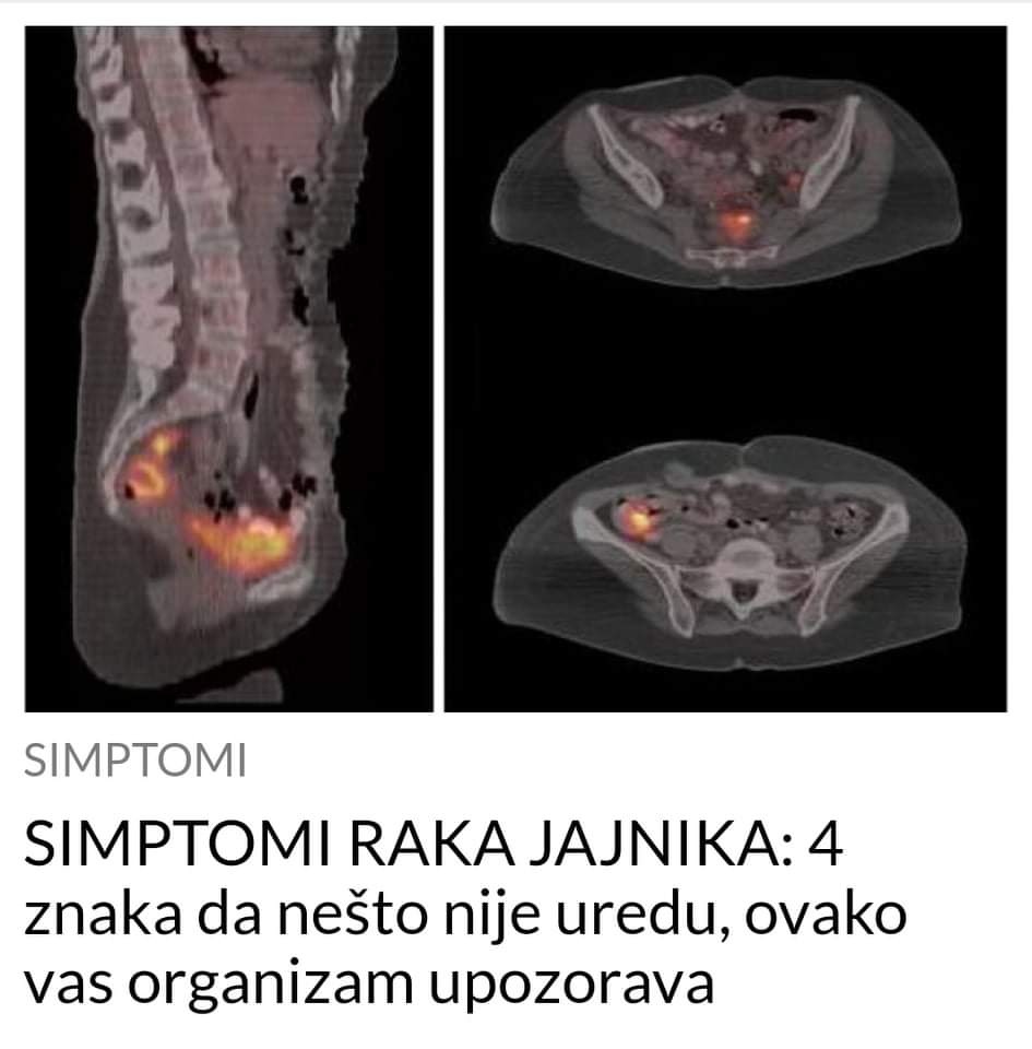 Pogledajte koji su to simptomi koji ukazuju da imate rak jajnika